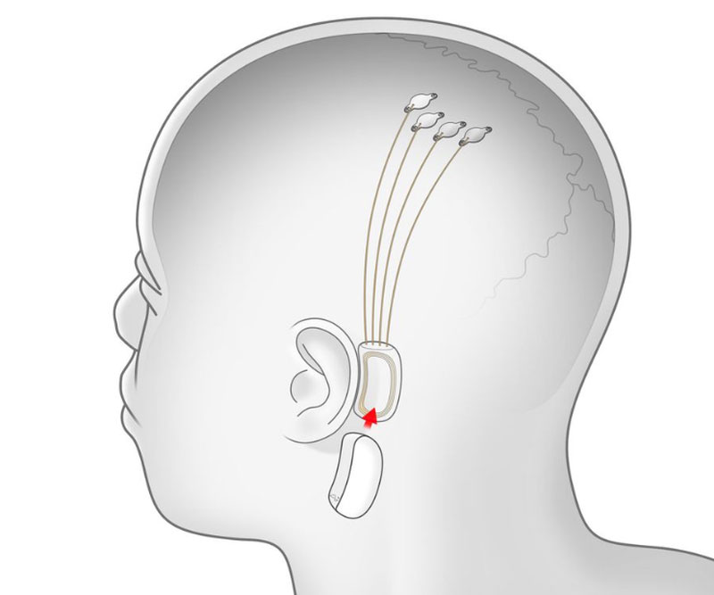 cerebro artificial