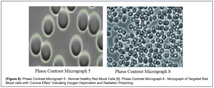 Las células de la izquierda son sanas, cóncavas. Las células de la derecha están huecas, no son cóncavas, han perdido la hemoglobina, lo que supone el "efecto de la proteína de la espiga" o "efecto Corona”.