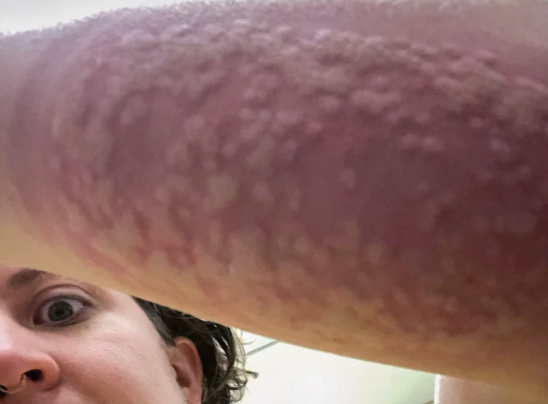 La voluntaria, Carolina Reid, muestra la hinchazón en su brazo después de ser picada por 200 mosquitos a la vez para ser dosificada con la vacuna experimental contra la malaria.